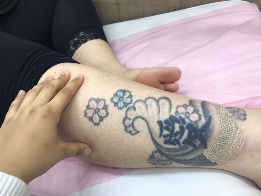 جلسة إزالة التاتو بواسطة كيو سويتشد ليزر في الغردقة